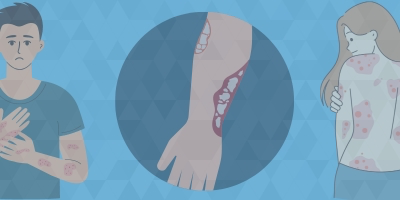 Designing Treatment Plans for Patients With Plaque Psoriasis