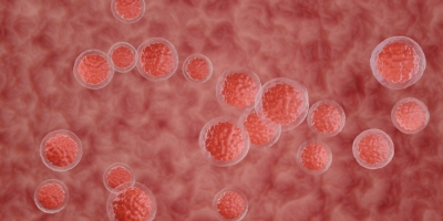 Cracking the Code to Successful Stem Cell Mobilization in Multiple Myeloma