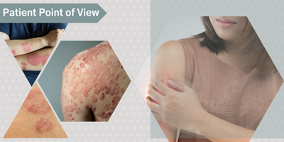 Patient Point of View: PDE4 Inhibitors for the Treatment of Adult Plaque Psoriasis