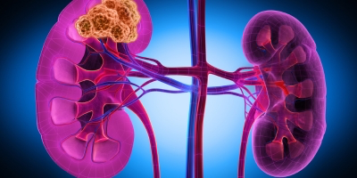 Toxicity Management and Symptom Control in Advanced RCC: Playbook Update